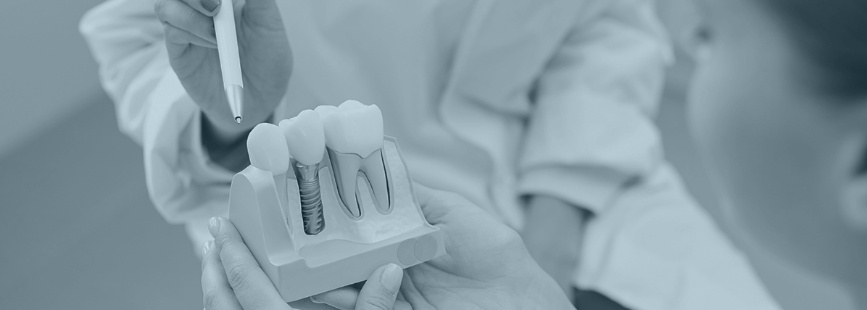 Implantologija - implantati - Idente