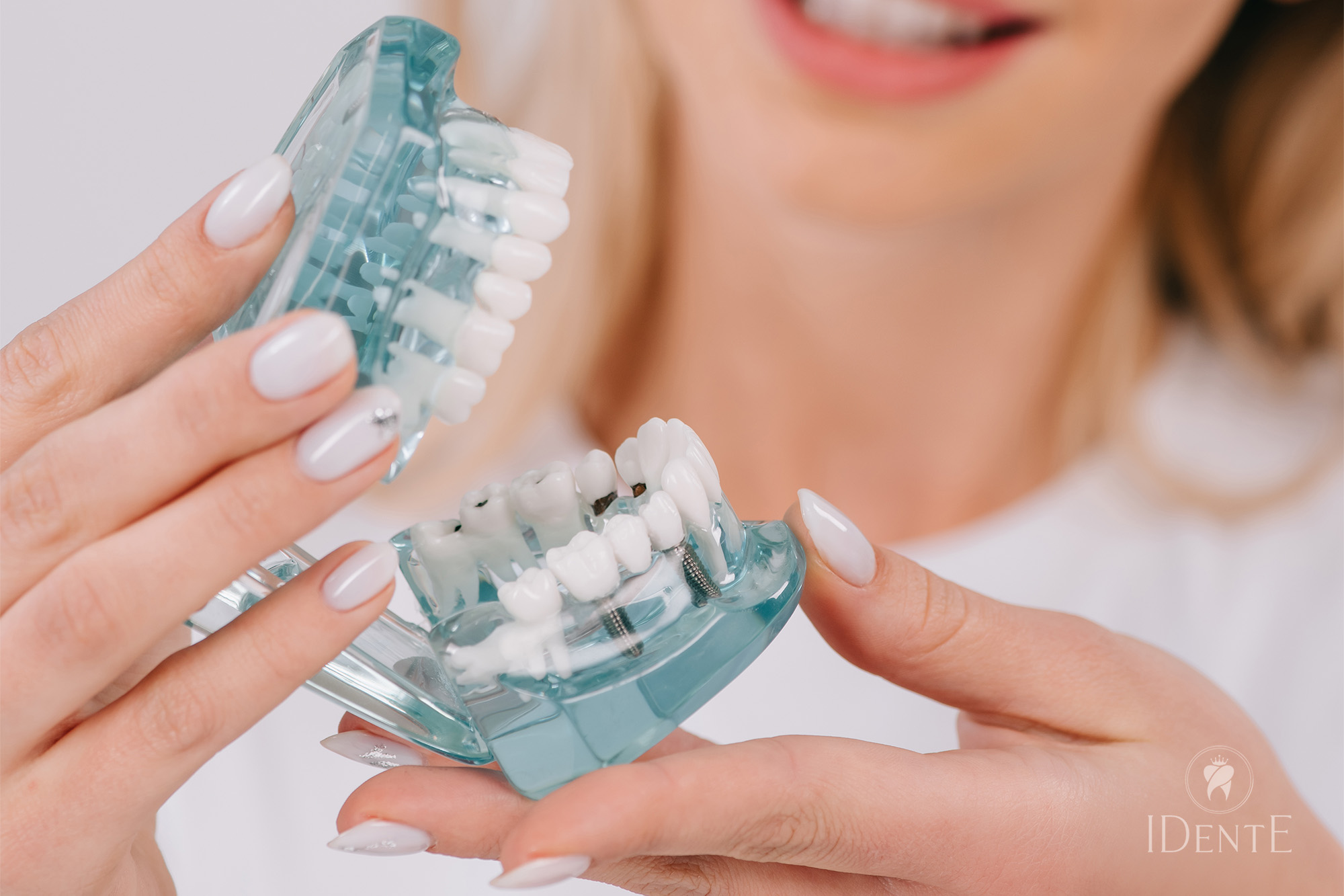 Zobni implantati: sodobna rešitev za povrnitev nasmeha – all-on-4