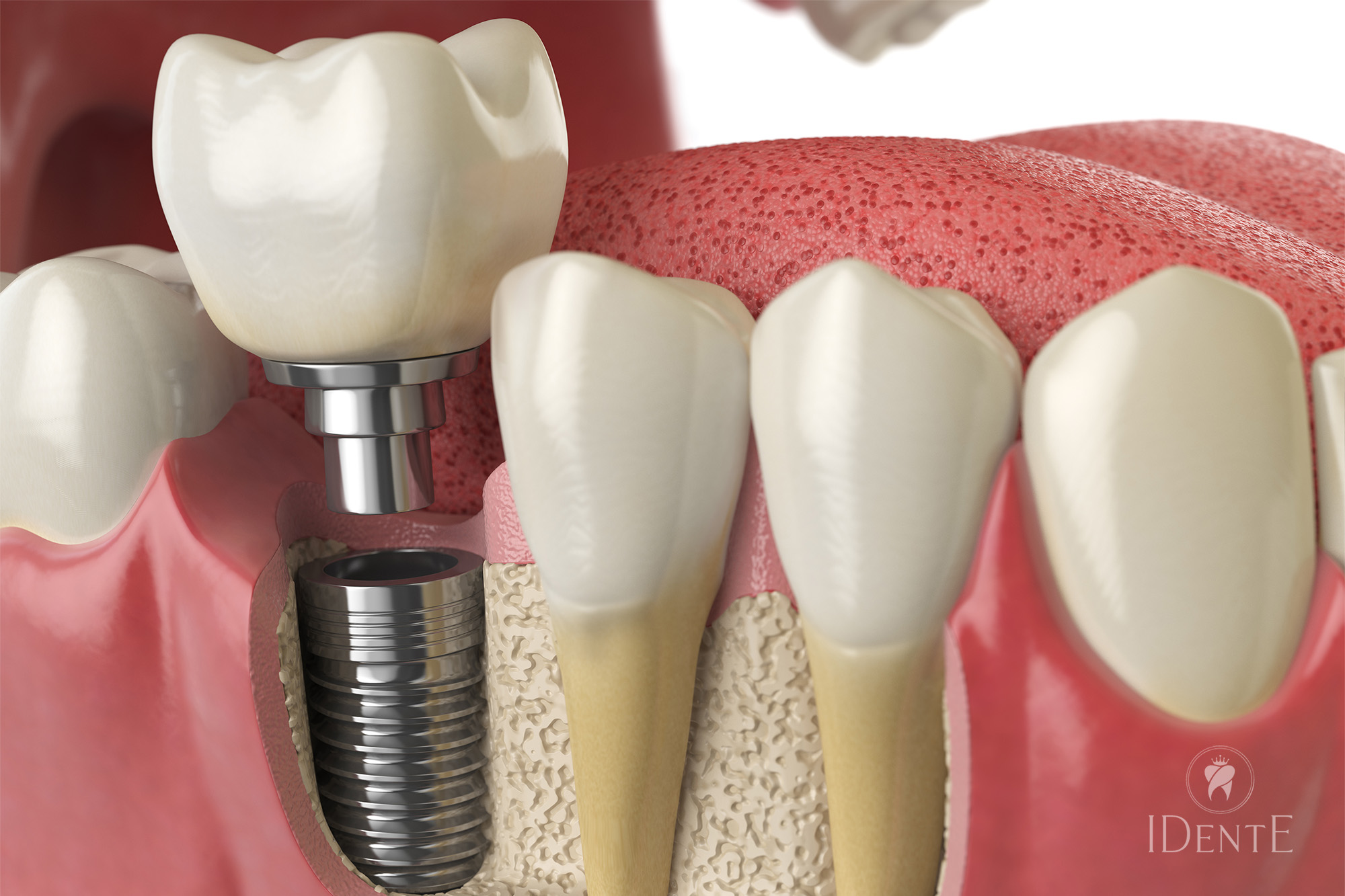 Zobni implantati: sodobna rešitev za povrnitev nasmeha