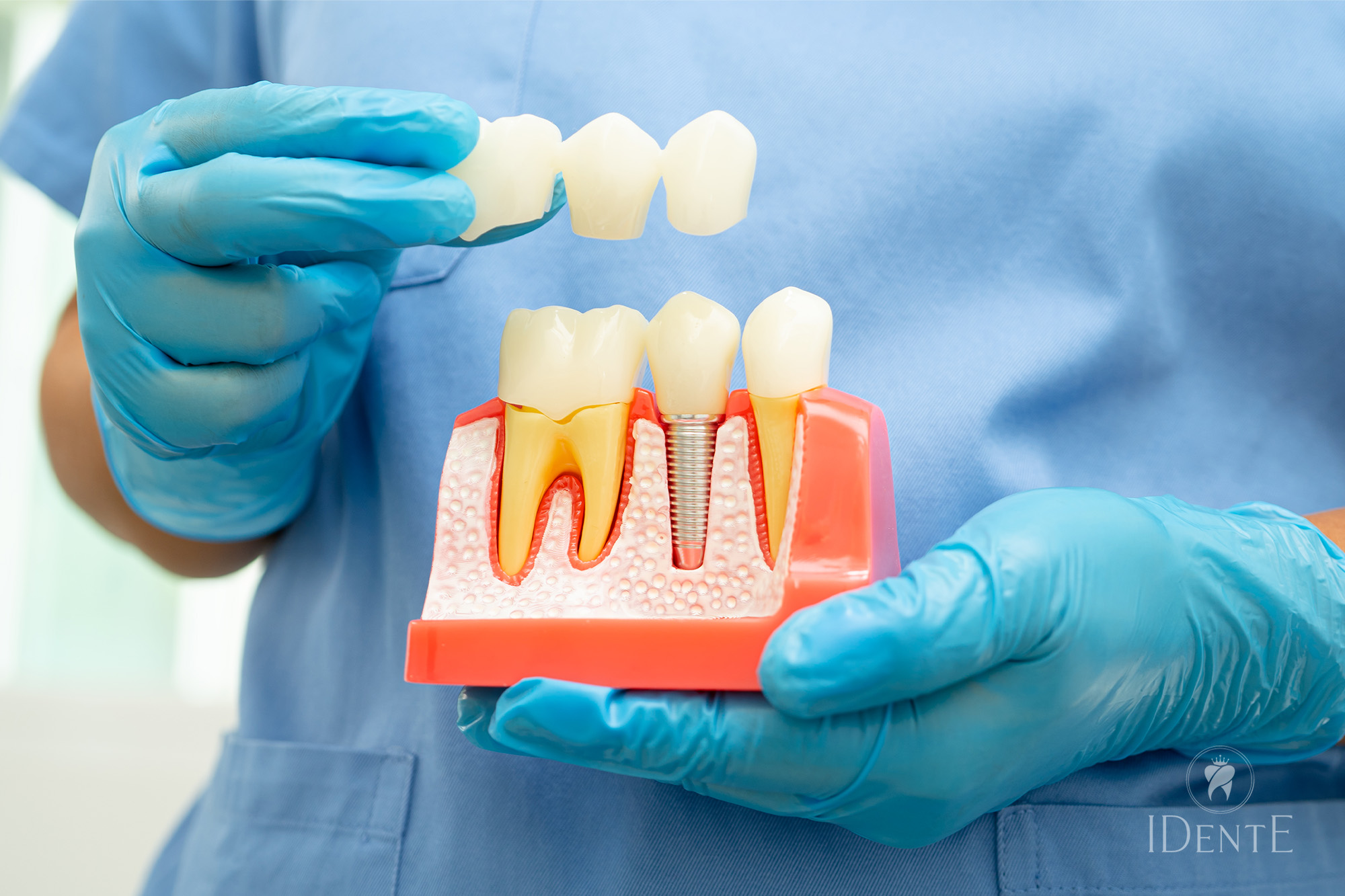 Brezobost – Možnosti za nadomeščanje zob – implantat