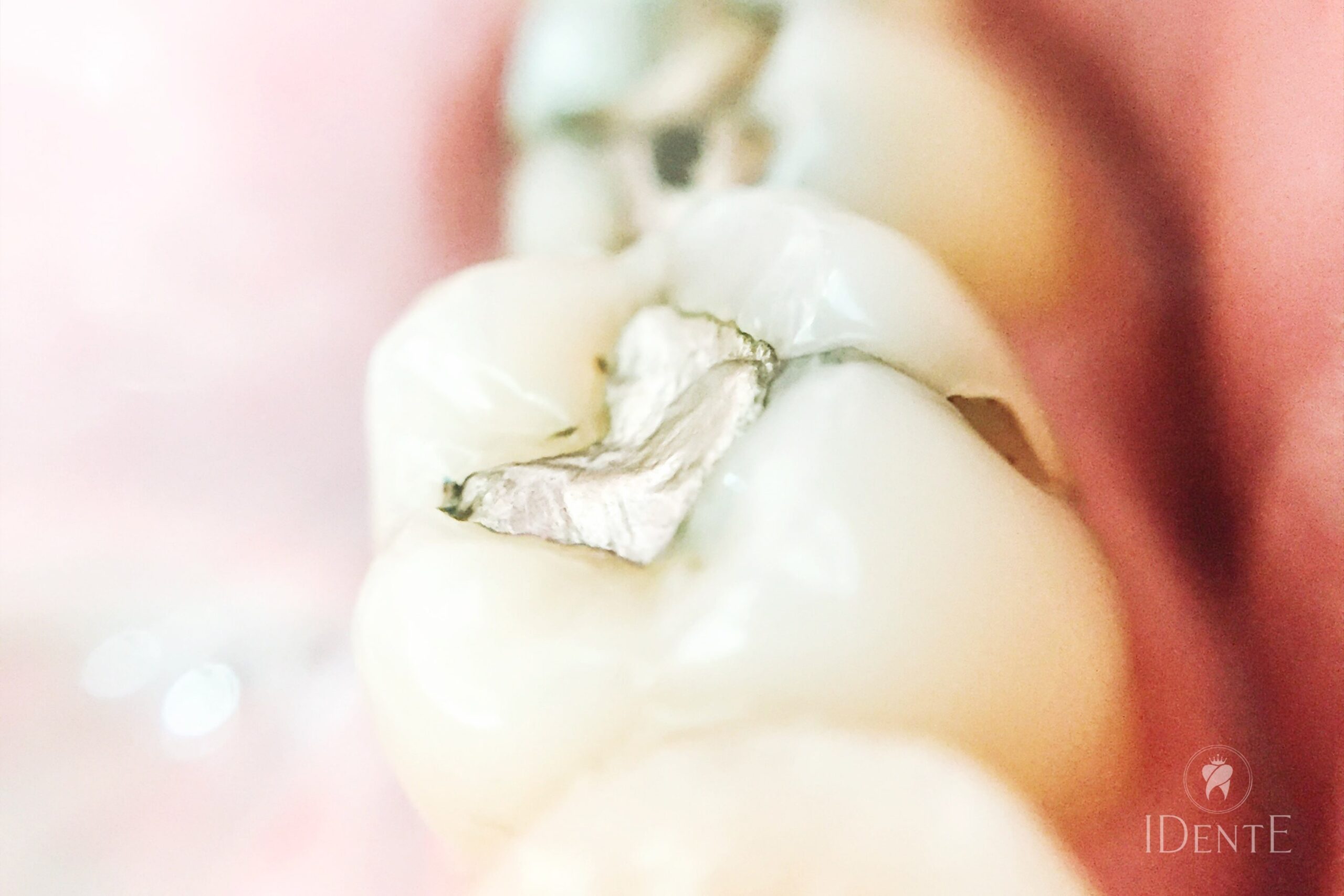 Amalgamske plombe in zakaj jih odstraniti - IDentE