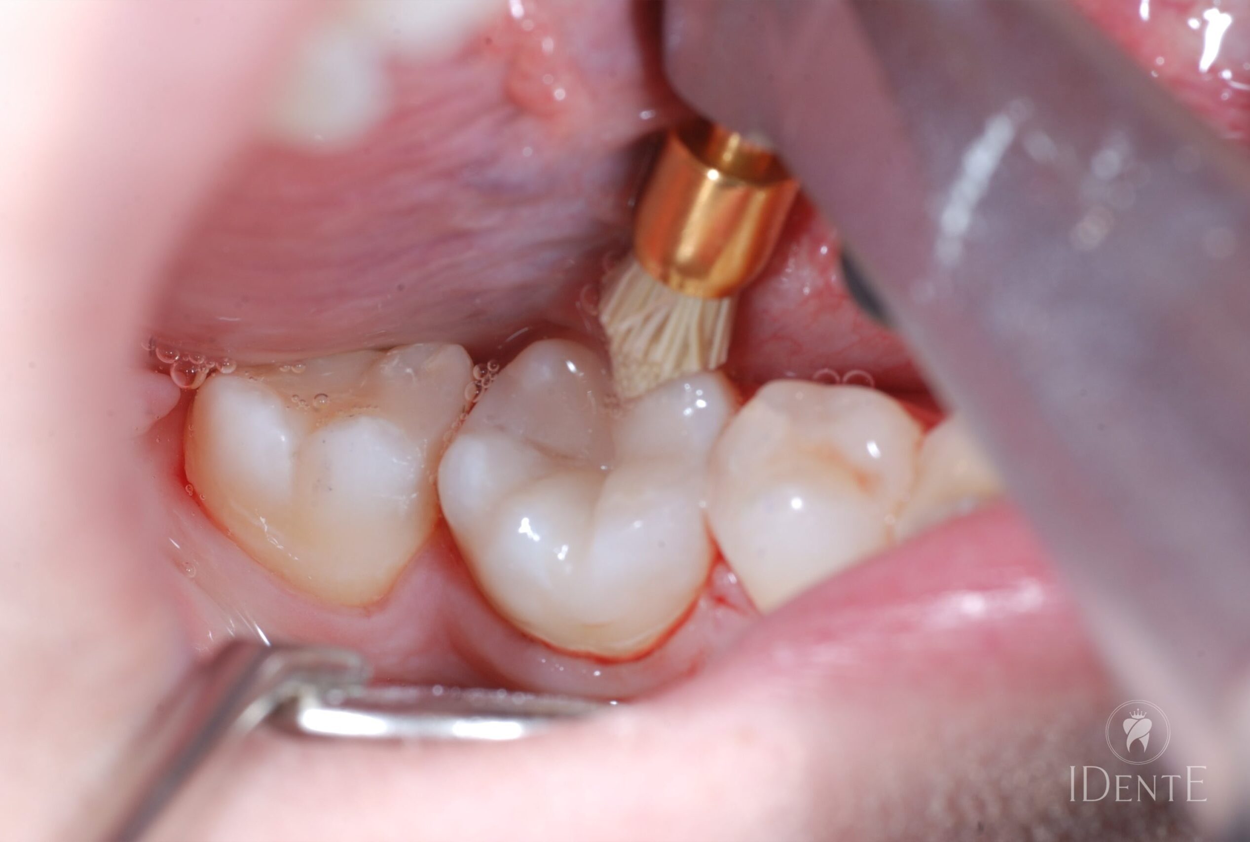 Amalgamske plombe in zakaj jih odstraniti - IDentE