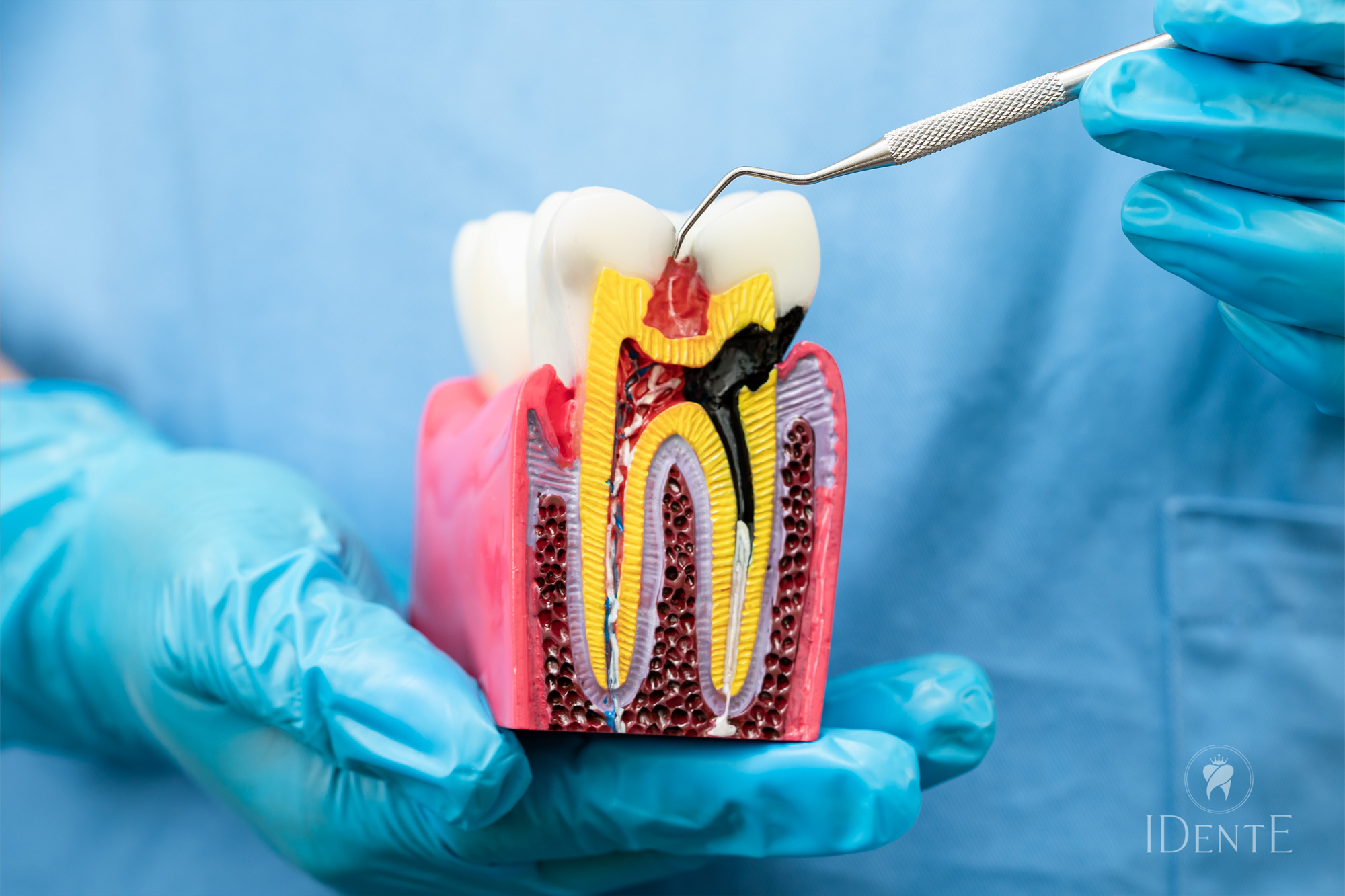 Endodontsko zdravljenje z Reciprocom: Prednosti strojne obdelave koreninskih kanalov