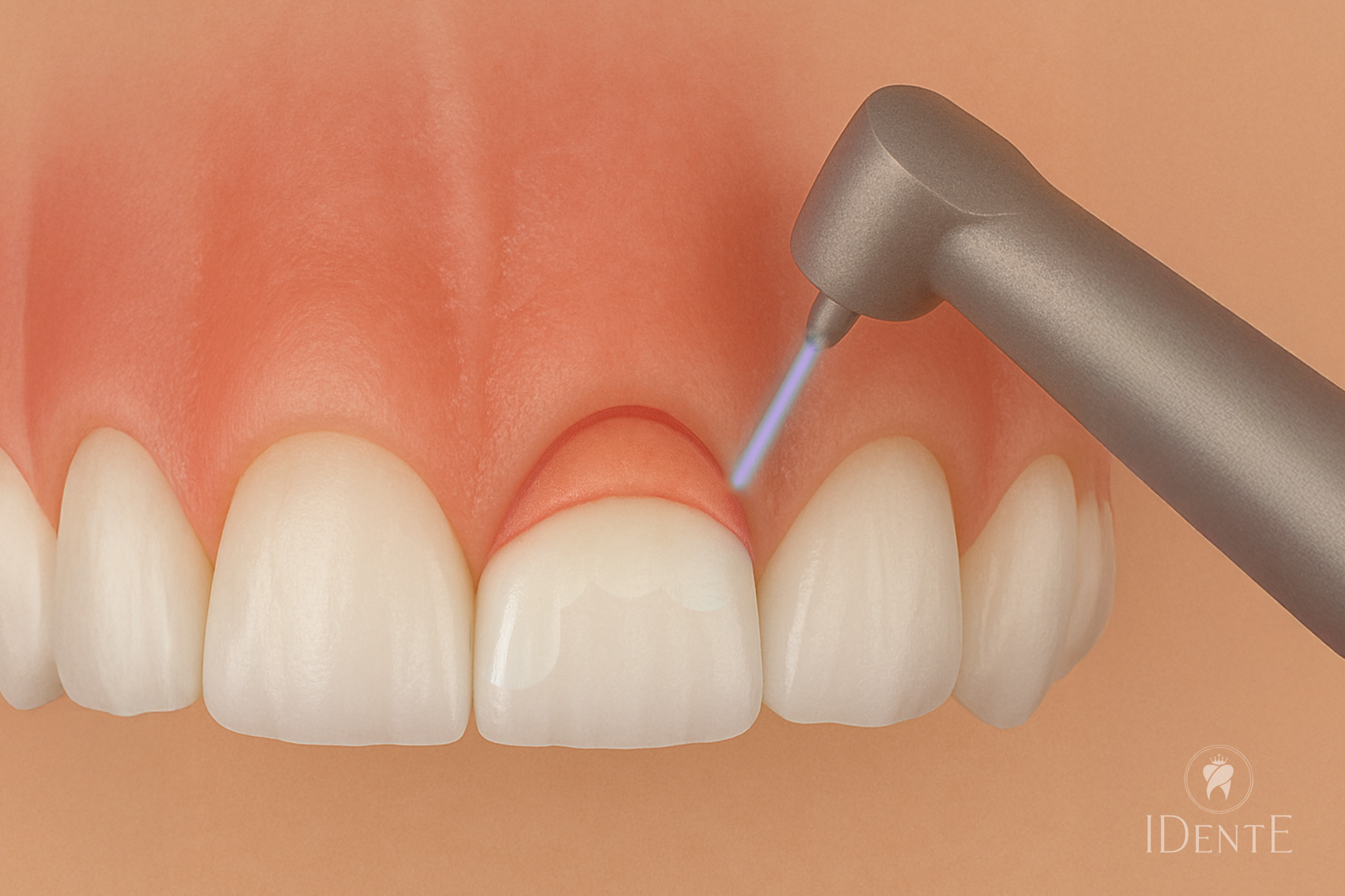 Gummy Smile operacija | 4 metode zdravljenja